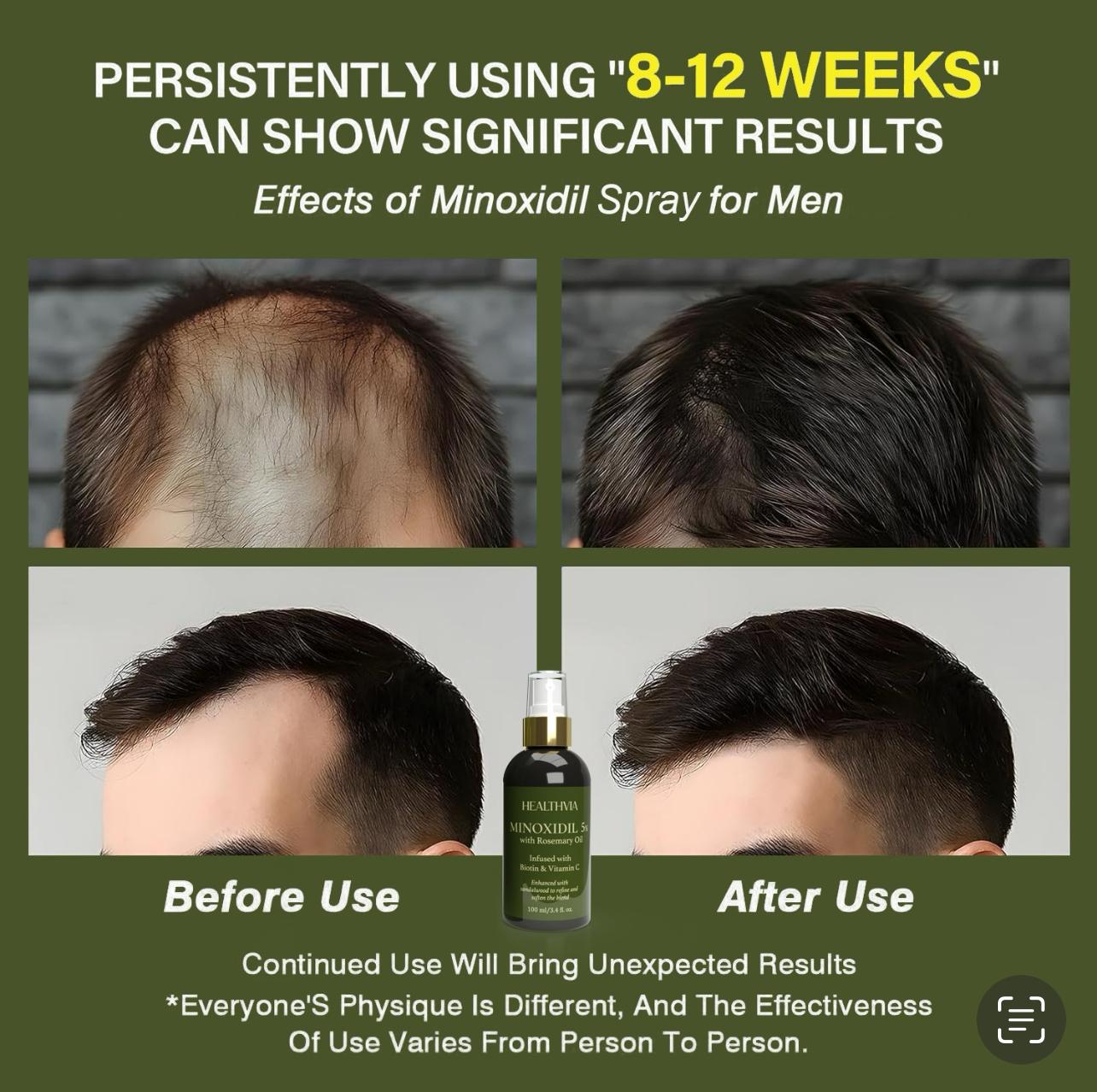 Minoxidil 5% Hair & Beard Growth Spray for Men & Women with Rosemary Oil, Biotin & Vitamin C – Fresh Sandalwood Scent, 100ml