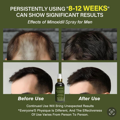 Minoxidil 5% Hair & Beard Growth Spray for Men & Women with Rosemary Oil, Biotin & Vitamin C – Fresh Sandalwood Scent, 100ml